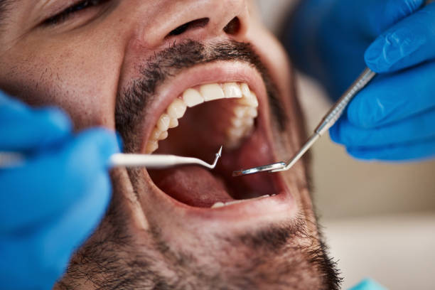 Best Emergency Tooth Extraction in Tremont, IL